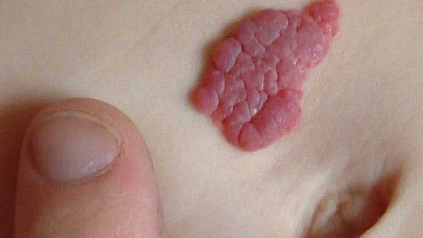 Angioma, hemangioma capilar o mancha en fresa. (Foto: Wikimedia)